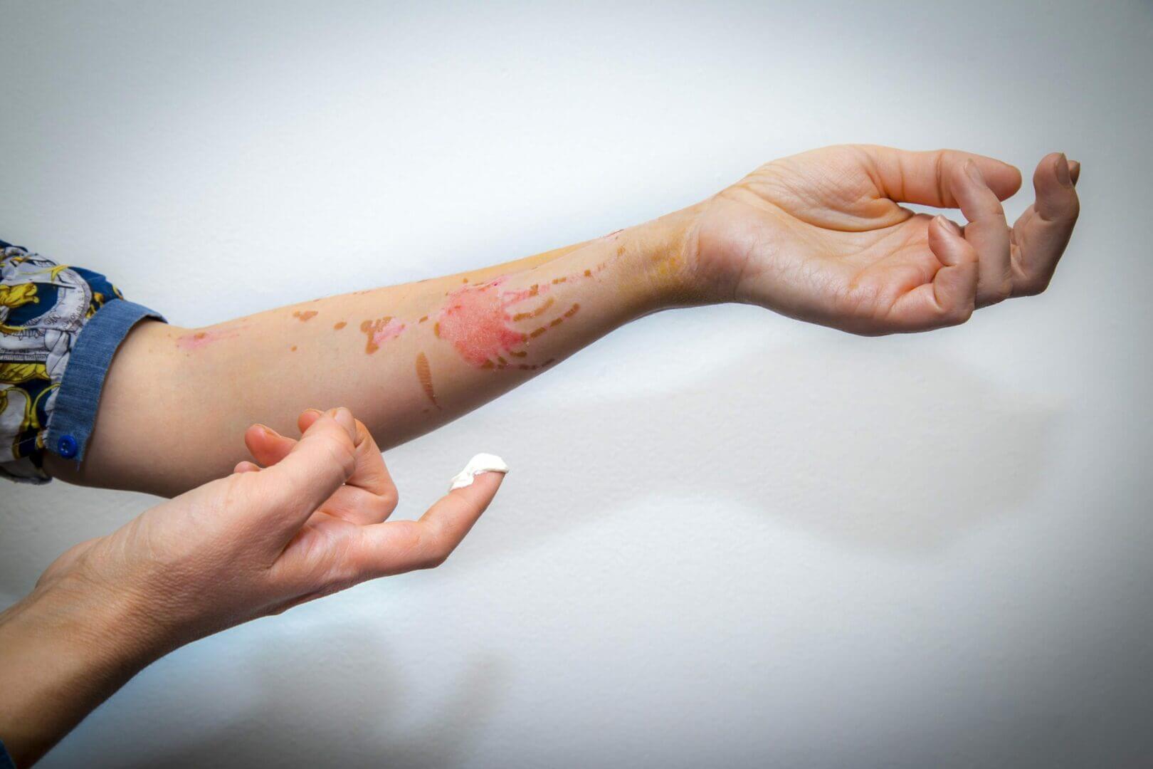 Een persoon smeert crème op een onderarm met huidirritatie en verkleuring, waarschijnlijk van te veel van de zon genoten. De arm is gestrekt, waardoor roodachtige vlekken zichtbaar worden tegen een effen witte muurachtergrond.