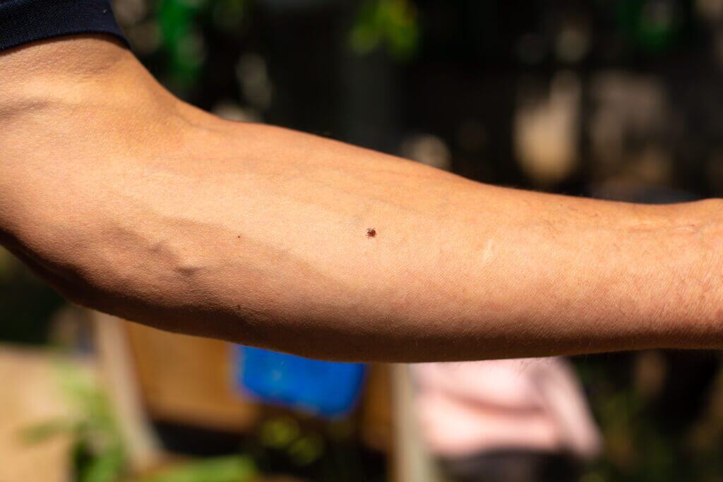 Een close-up van de onderarm van een persoon toont een kleine teek die op de huid vastzit. Dit benadrukt hoe belangrijk het is om te weten dat je een teek moet verwijderen. De achtergrond is zacht vervaagd met een vleugje groen en zonlicht.